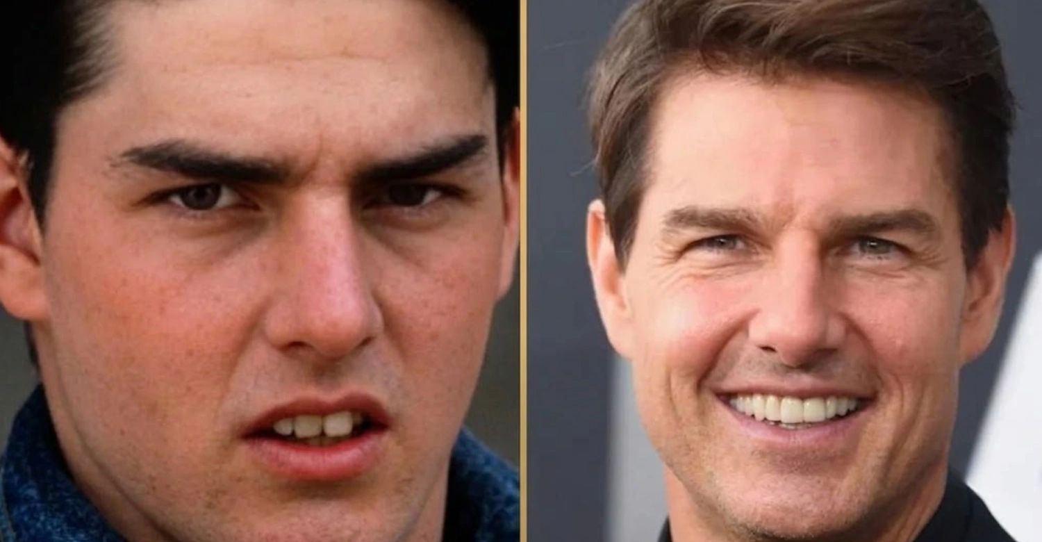 Tom Cruise teeth before and after